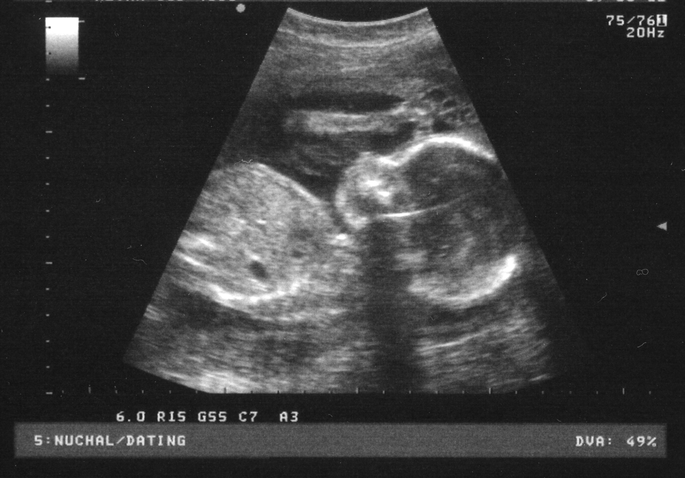 ultrasound of 22 week old